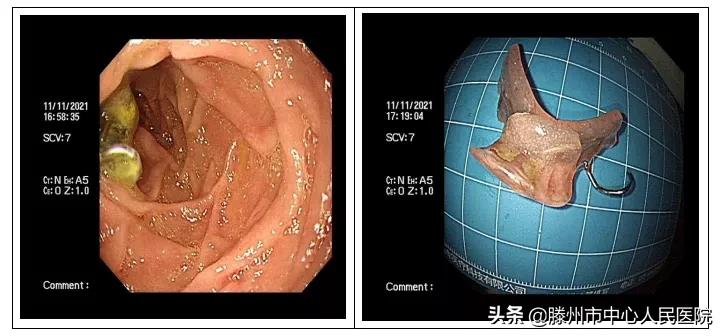 内镜下成功取出食管异物,消化内科取异物