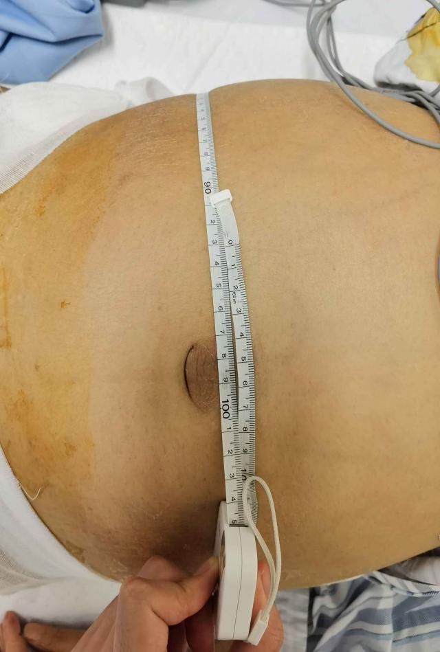 一周内肚子大得像孕妇，深圳医生巧手建通道“治水”