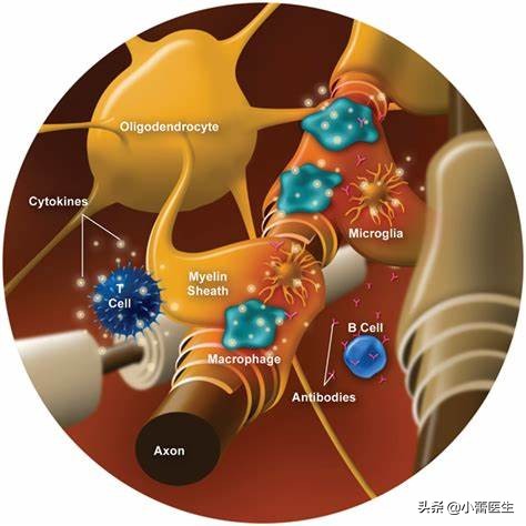 让“风湿病”患者又爱又恨的“激素”，医生帮您化解矛盾！