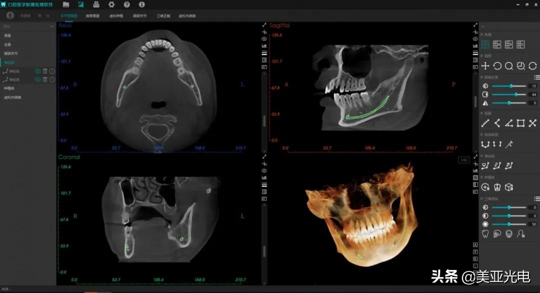 美亚口腔cbct全新局部ct功能上线,口腔cbct最好的品牌