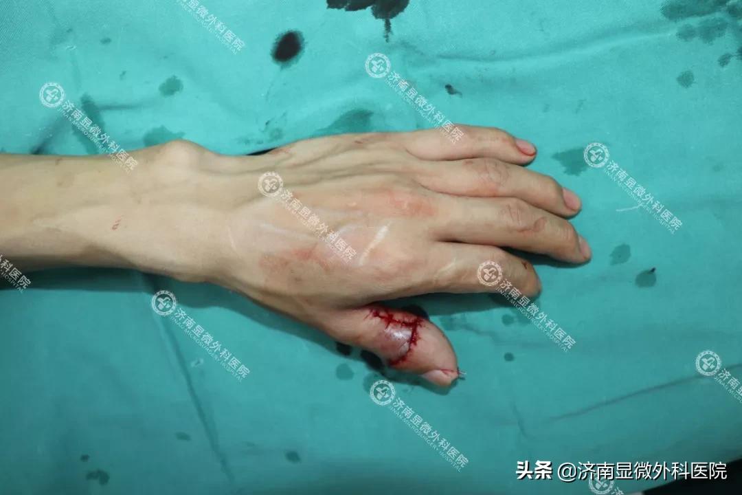 拇指缺失为什么影响这么大？手指再造中心如何找回缺失的手指？