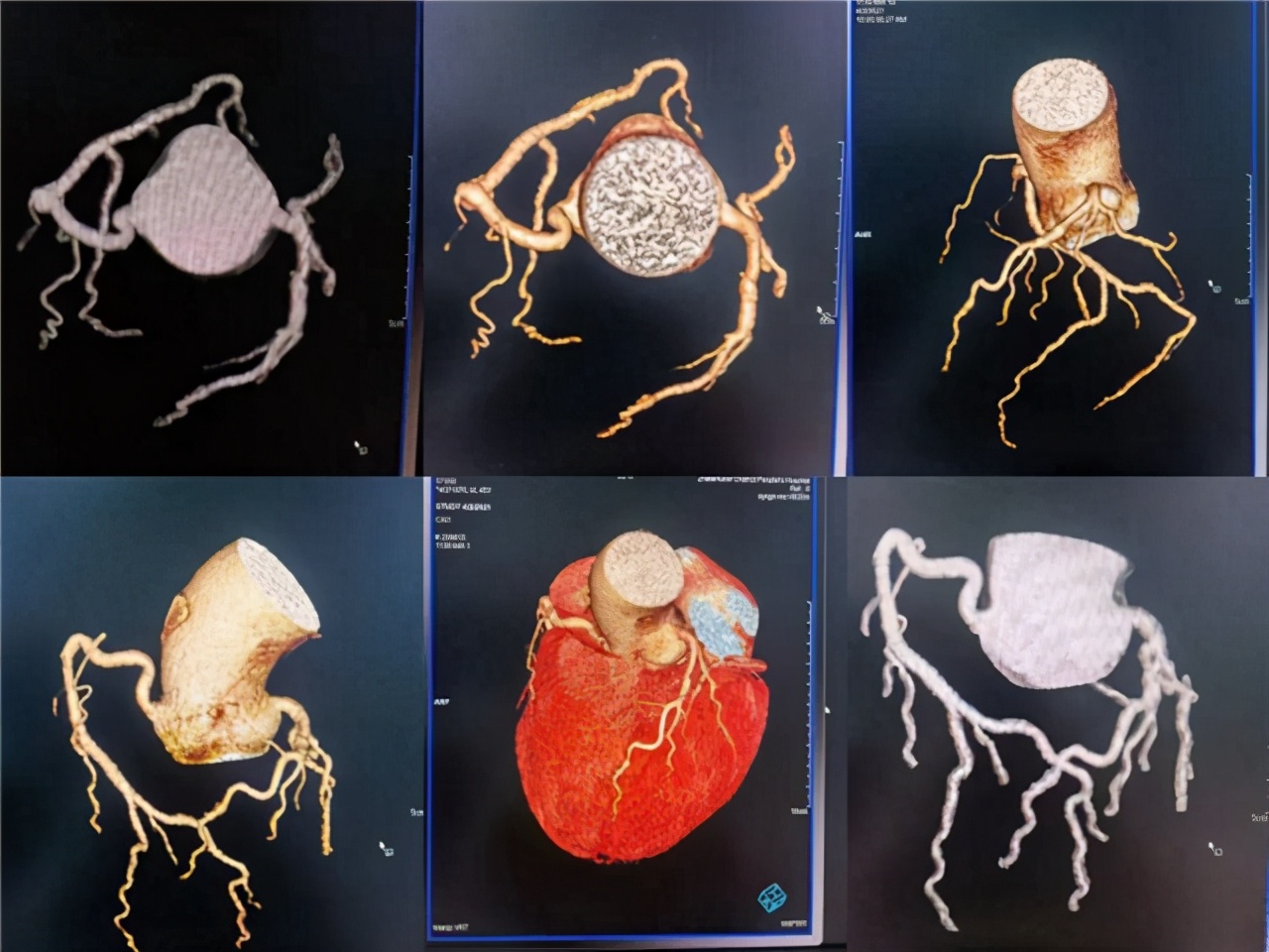 冠脉ct和冠脉造影的间隔时间多长,冠脉造影ct是怎么检查的
