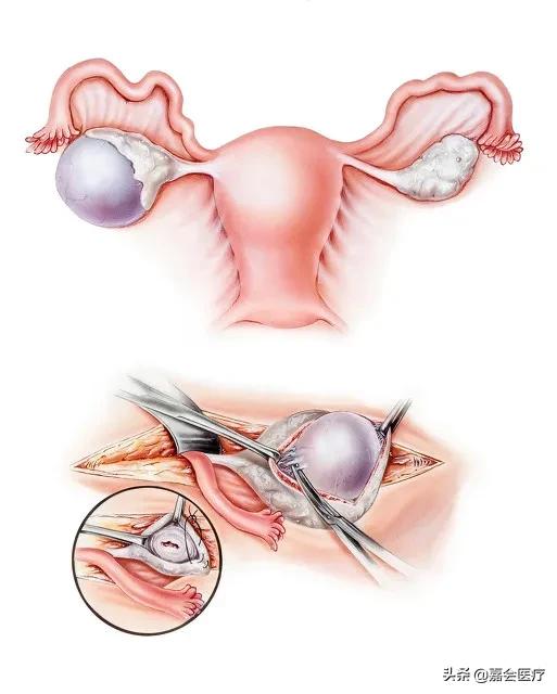 孕期发现囊肿该注意什么,孕期发现子宫囊肿