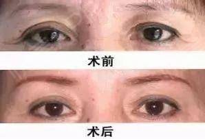 人衰老面部变化,面部衰老改善最好的方法