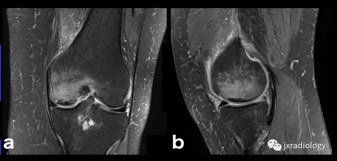 磁共振天天诊断骨髓水肿，但您知道原因吗？