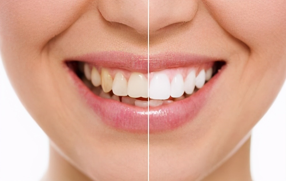 皓齿美白的真实感受,皓齿美白后酸痛严重