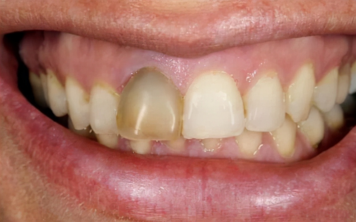 14岁牙齿黄可以洗牙变白吗,牙齿出血发黄去洗牙