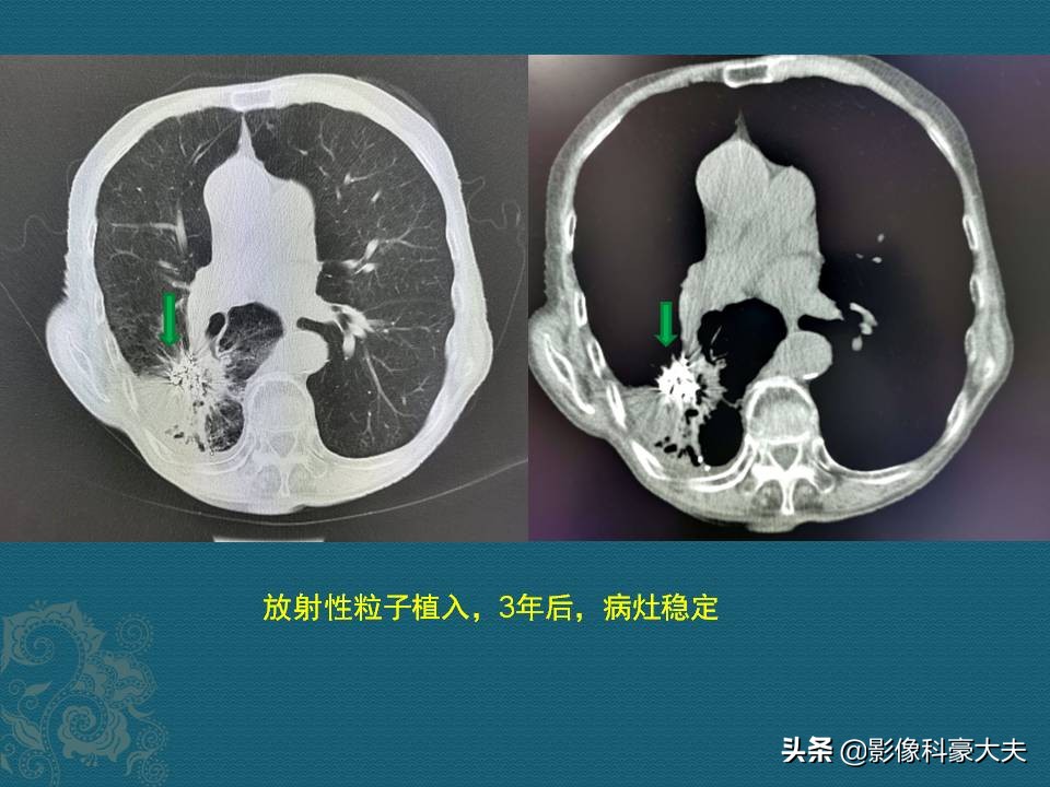 查出癌症后别绝望,癌症保守治疗的最新治疗方法