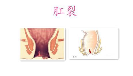 婴儿肛裂怎么办,哺乳期肛裂怎么办