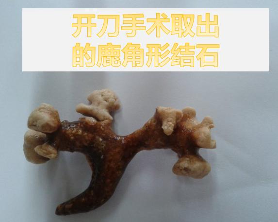 鹿角型结石最严重的后果,疯狂的石头肾脏