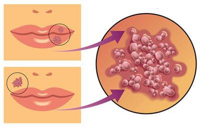 嘴边起泡是什么病毒,嘴边上火起泡可以用红霉素软膏吗