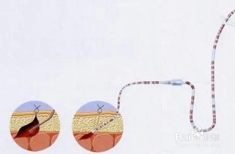 脂肪液化伤口不愈合需要注意什么,伤口液化不愈合会一直液化吗