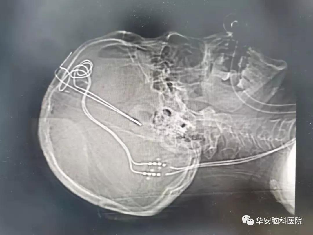 梅杰氏综合征dbs手术成功率,梅杰综合征微创手术打几个孔