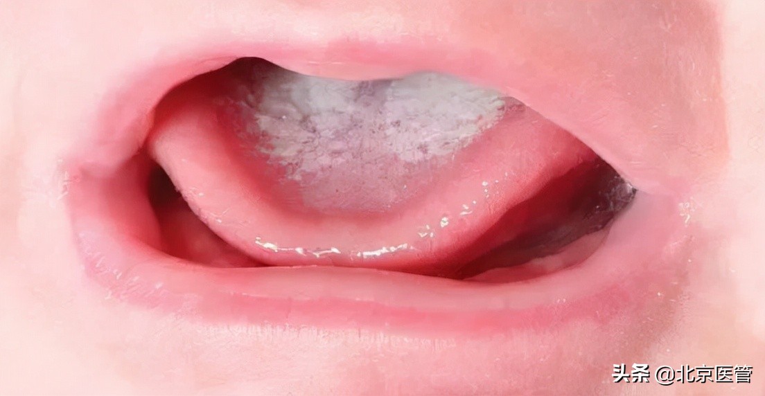 宝宝得了鹅口疮怎么解决,宝宝鹅口疮最佳解决方法