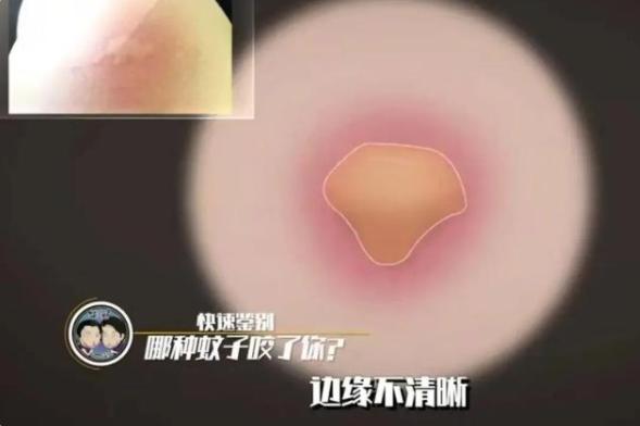 三种常见蚊子咬的包如何快速止痒消除,三种被叮的包要分清楚