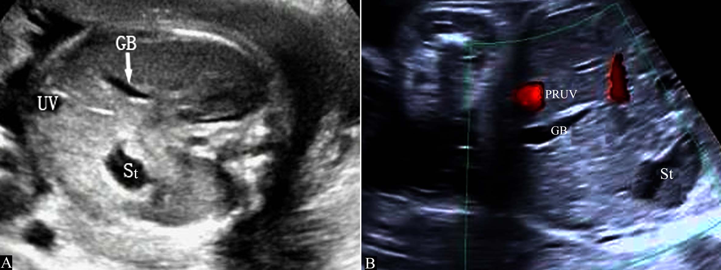 做彩超可以看出来脐带多长吗,超声检查脐带绕颈一圈正常吗
