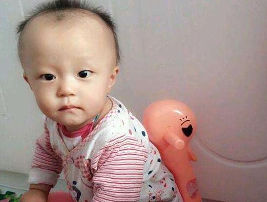 6个月婴儿发际线m型怎么办,七个月宝宝发际线高怎么办