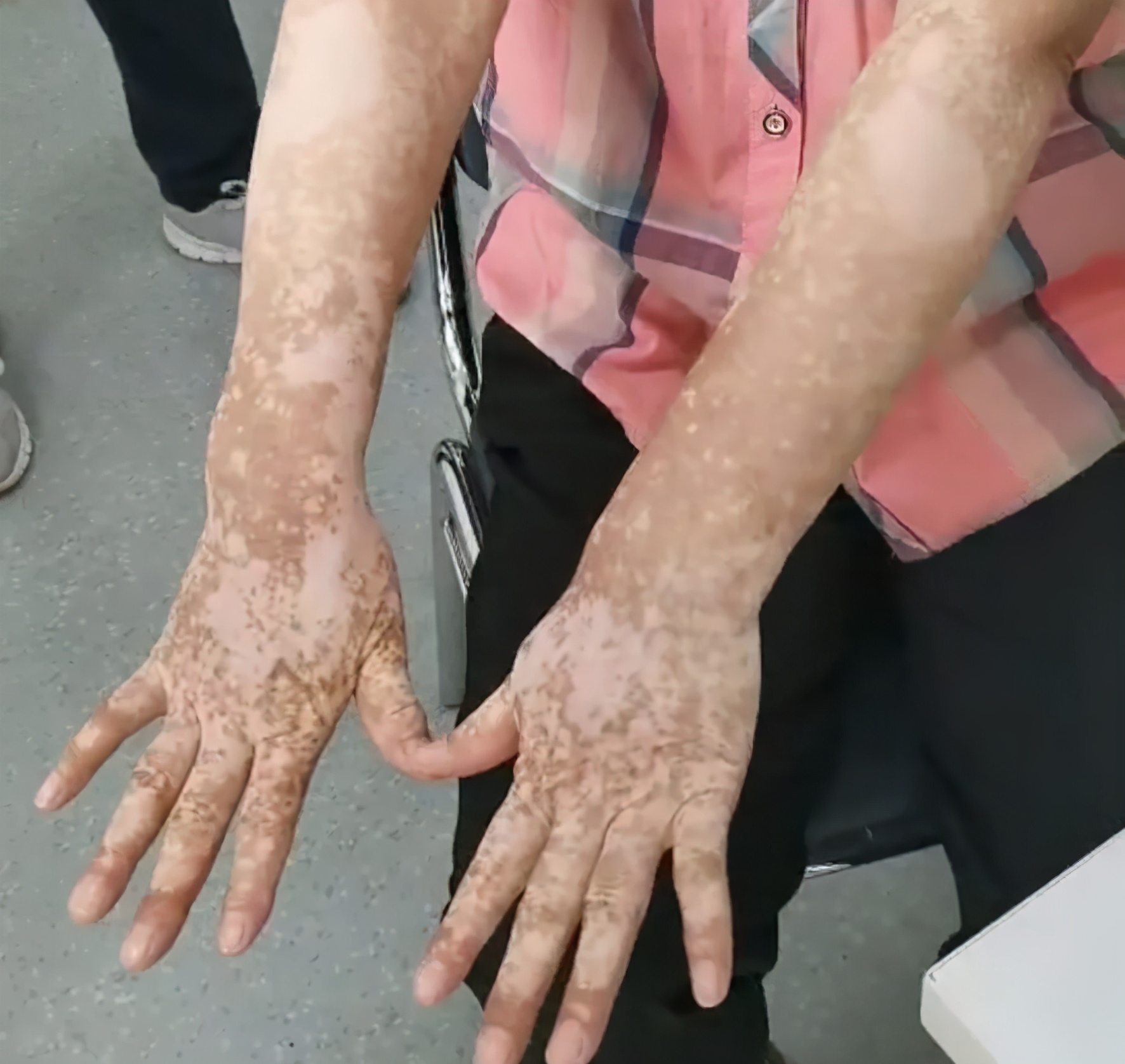 用了祛斑产品会得白癜风吗,用十多天就能变白祛斑的护肤品