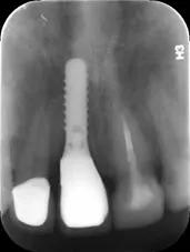 我才20岁为什么牙齿会碎掉,27岁缺牙不补有什么坏处