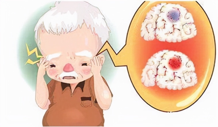 腔隙性脑梗死严重吗,腔隙性脑梗死一般寿命多长