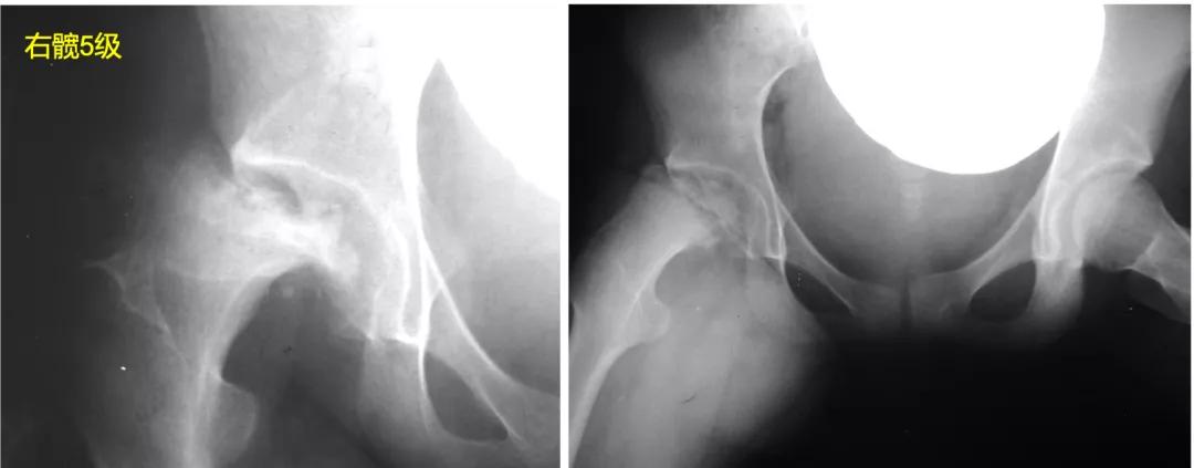 perthes可以治愈么,儿童股骨头坏死指南2020