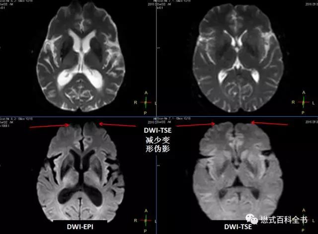 dwi成像序列,dwi序列和edwi序列