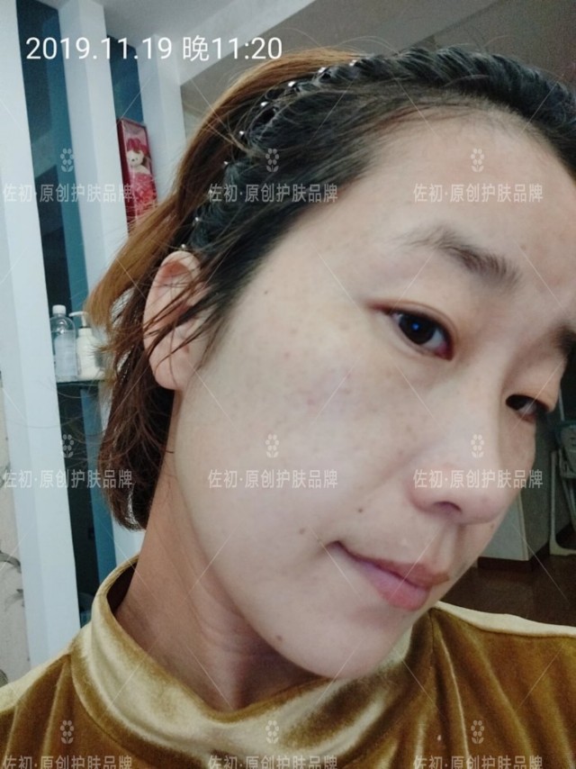 生完孩子烂脸,生完孩子脸上垮了怎样处理