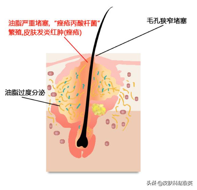 疮疡病病人的症状,疮是怎么引起的怎么治