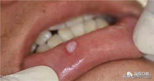 口腔内嘴唇囊肿是什么原因引起的,口腔粘液腺囊肿的原因和治疗方法