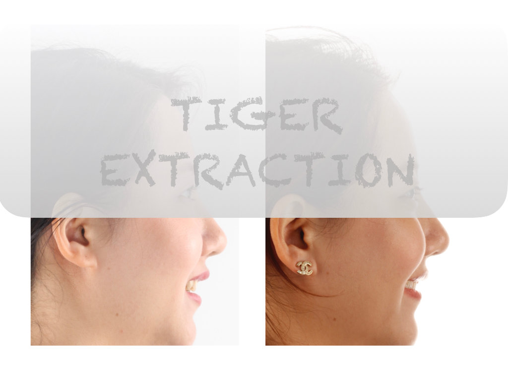 正畸医生邰怡的作品,南京牙齿矫正邰医生