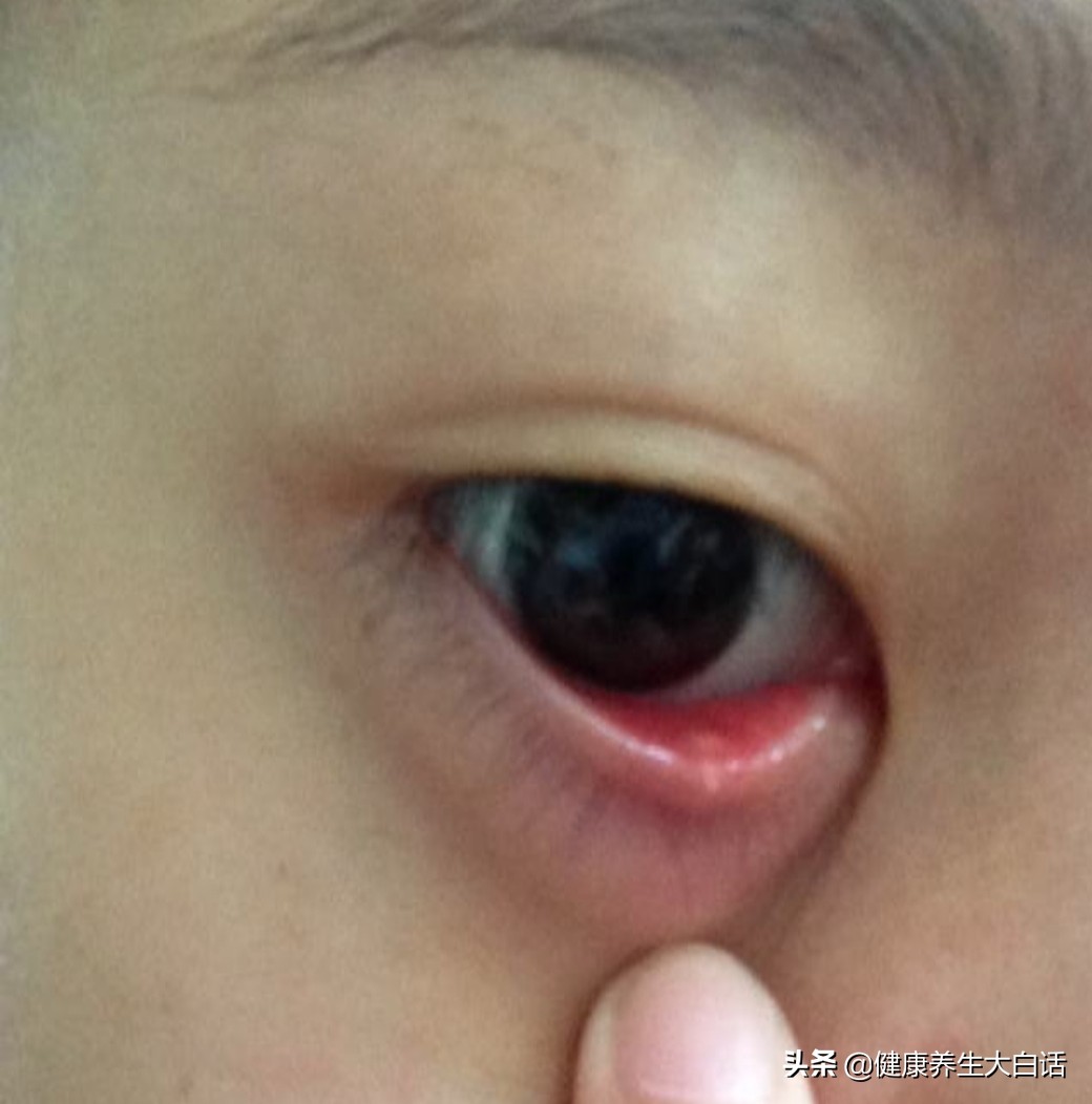 解决麦粒肿,生活小妙招麦粒肿