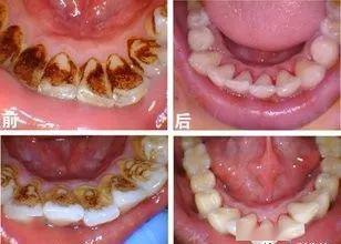 12岁牙齿有黑线怎么办自己怎么治,牙齿有黑线怎么预防不发展成龋齿