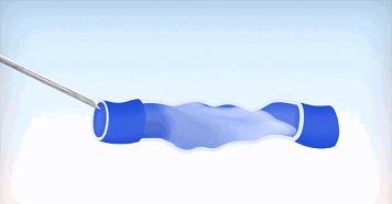 精索静脉曲张的误区,当心陷入静脉曲张的误区