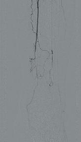 负压封闭引流治疗糖尿病足的原理,糖尿病足血管闭塞怎样治疗好