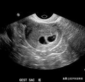 内见卵黄囊,卵黄囊肿瘤