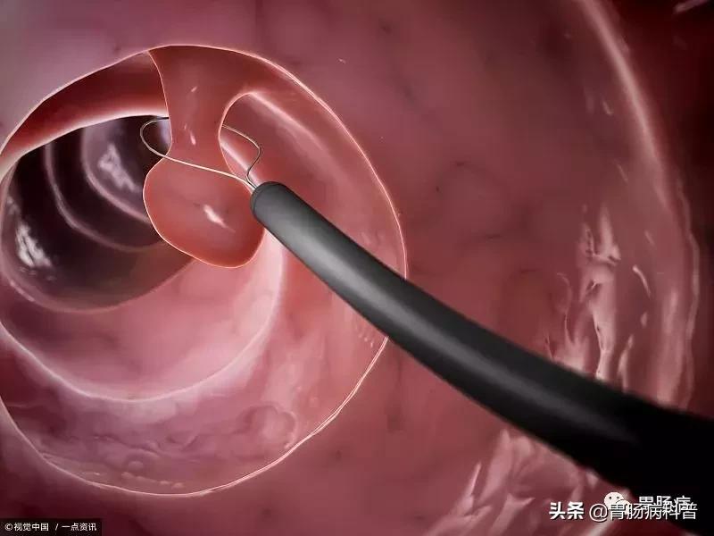 胃增生性肠息肉严重吗,胃体增生性的息肉是什么意思