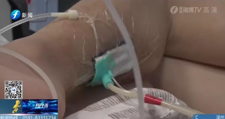 一个人在家里被大狗咬了,宠物猫咬主人一口主人被截肢