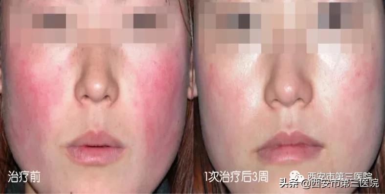 光子嫩肤的魅力,光子嫩肤带你美下去