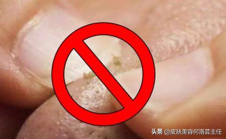 去黑头的方法快速有效,去除黑头以后皮肤该如何护理