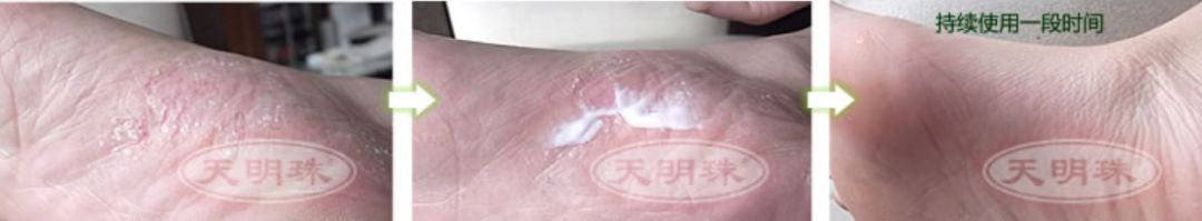 冬天脚后跟干裂用什么润脚霜,润足脚后跟干裂修复霜