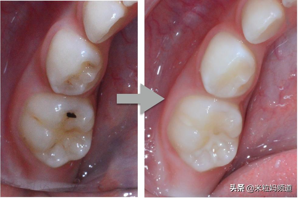 小朋友的蛀牙是怎么形成的,10岁小孩有7颗蛀牙