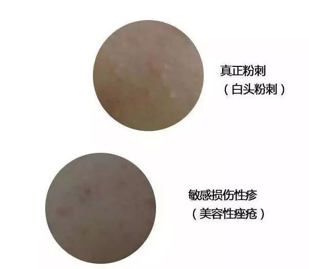 祛除闭合性粉刺软膏有哪些,下巴有闭合性粉刺怎么祛除