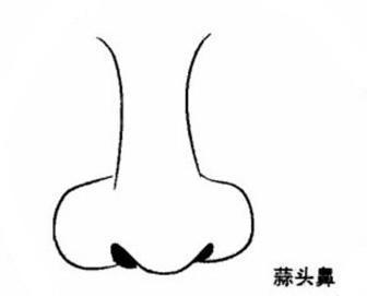 蒜头鼻露鼻孔怎么矫正,蒜头鼻怎么矫正最有效