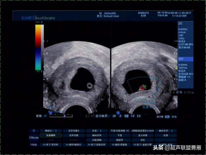 内见卵黄囊,卵黄囊肿瘤