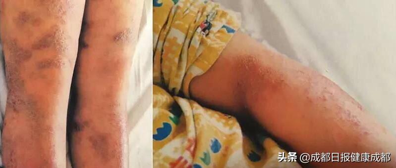 便宜又好的实用的皮肤病药,治疗皮肤病痛苦吗