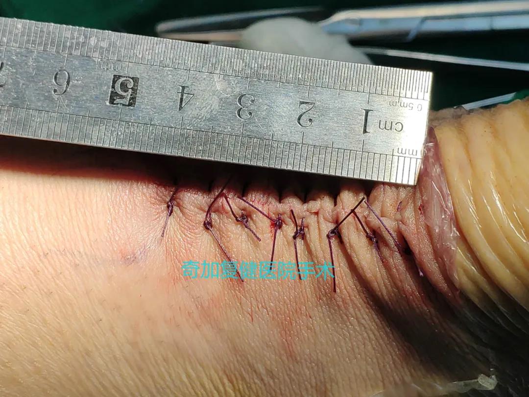 跟腱自发性断裂,跟腱断裂全负重行走