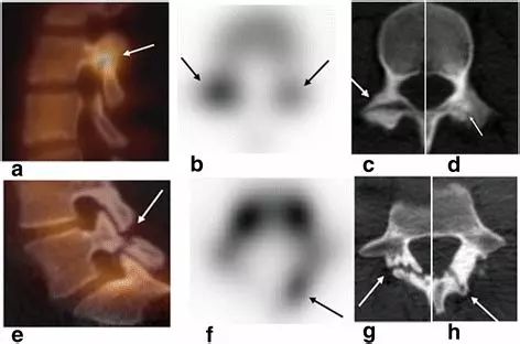 椎弓崩裂怎么知道是先天还是后天,椎弓崩裂的原理