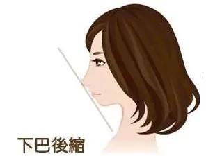 侧颜很难看是因为什么,侧颜不好看怎么修