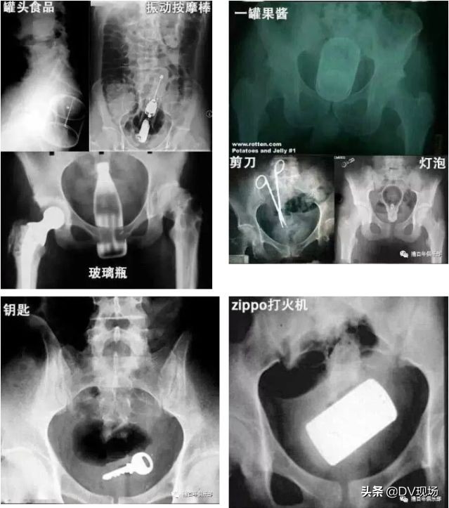 大叔将花露水瓶塞入直肠，一问缘由竟是为了止痒
