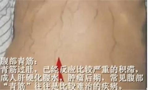 青筋明显说明肝脏出了大问题,青筋暴起的病